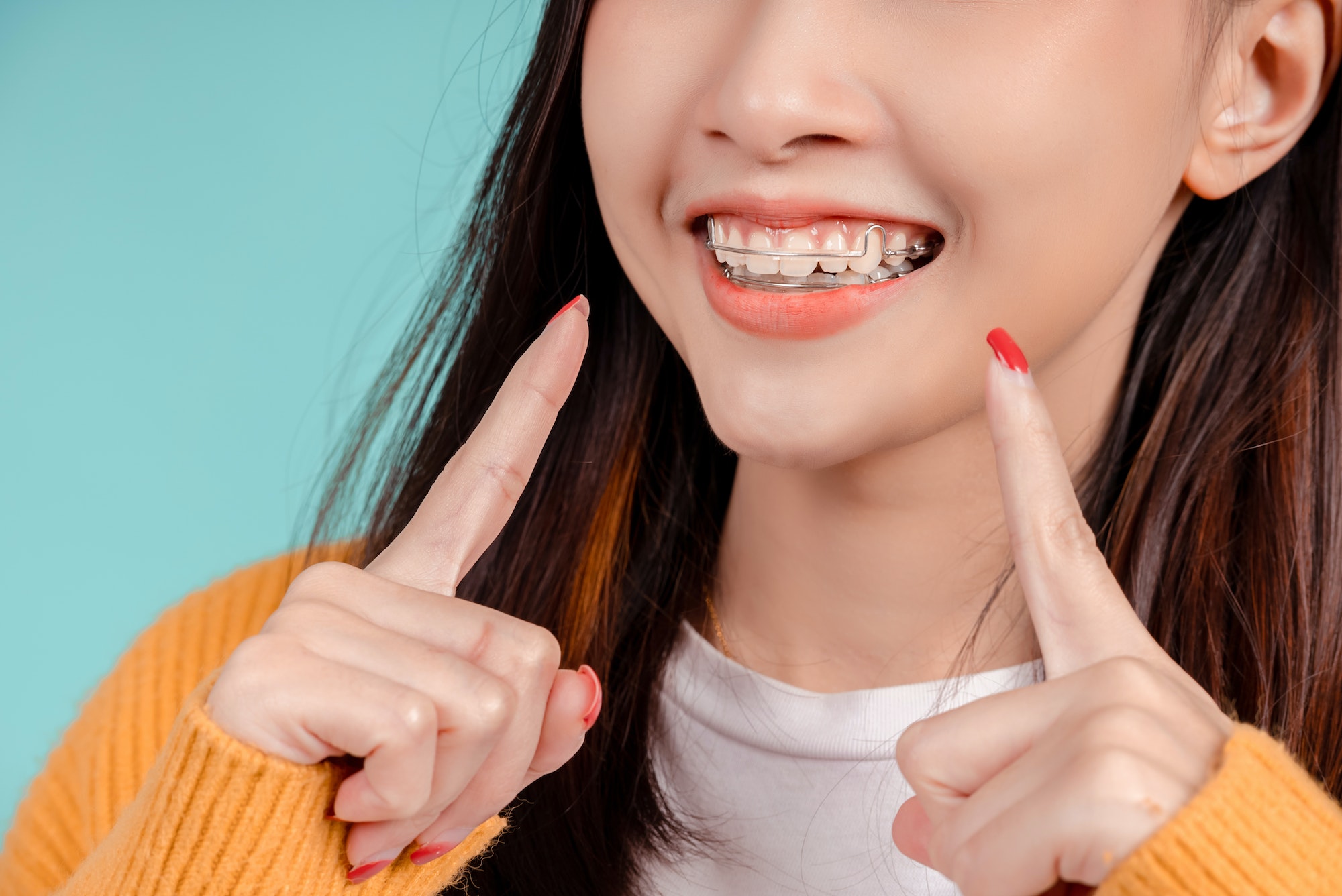 Dental Beautiful smiling of young asian woman with retainer braces